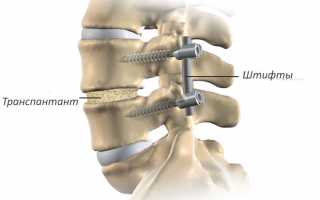 Проведение спондилодеза поясничного, шейного и грудного отдела позвоночника