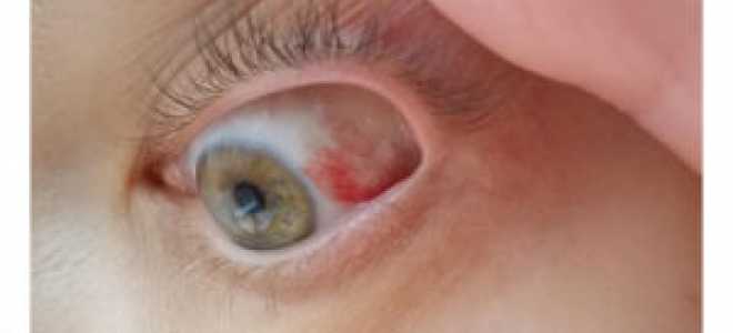 Покраснение глазного яблока