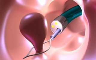 Методы диагностики и избавление от полипов в анальном канале