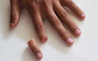 Особенности протезирования пальцев рук и ног