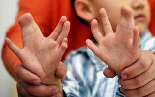 Причины синдактилии (сросшихся пальцев) и ее лечение