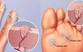 Классификация полипов на коже, группы риска и методы их удаления