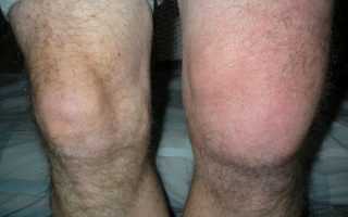 Признаки синовита коленного сустава и методы его лечения
