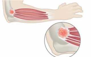 Способы лечения латерального эпикондилита локтевого сустава