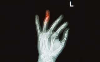 Проведение рентгена кисти руки и результаты обследования