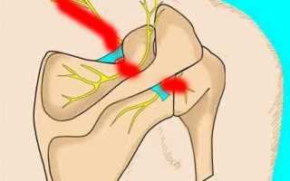 Что делать, если защемило нерв под лопаткой?