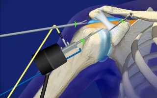 Проведение артроскопии плечевого сустава и восстановление после операции