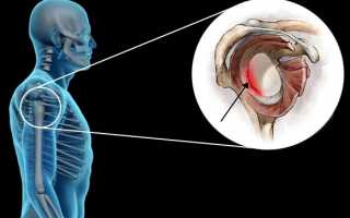 Операция плечевого сустава при повреждении Банкарта
