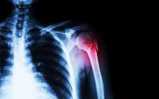 Почему возникает некроз головки плечевой кости и как его лечить?