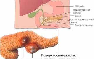 В чем причина возникновения полипов в поджелудочной железе и как их лечить
