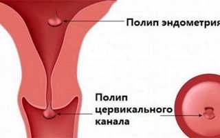 Обязательно ли удалять полип цервикального канала, и что будет если не лечить патологию?