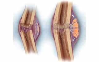 Как долго длится консолидация костей при переломах?