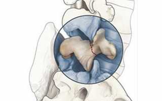 Почему развивается спондилолиз L5 позвонка и как его лечить?