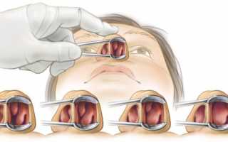 Чем отличаются полипы от аденоидов в носу и как их лечат