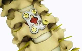 Что такое ламинэктомия позвоночника и как ее проводят?