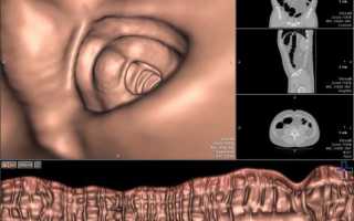 Мнение врачей о виртуальной колоноскопии и пациентов, которые уже её прошли