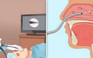 Операция по удалению полипов в носу, восстановление и дальнейшая профилактика