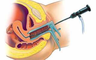 Как проходит гистероскопия полипа эндометрия и на какой день её назначают