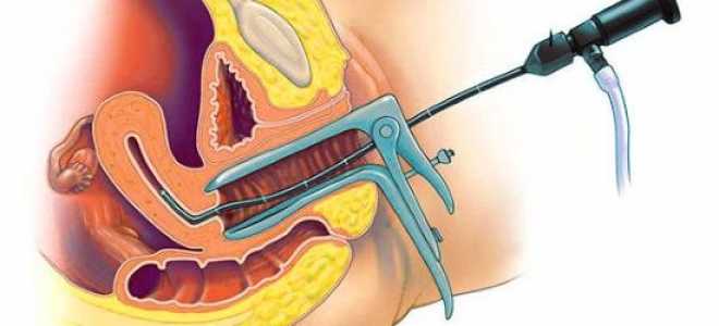 Как проходит гистероскопия полипа эндометрия и на какой день её назначают