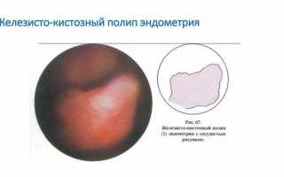 В чем опасность железистого полипа и реабилитация после его удаления
