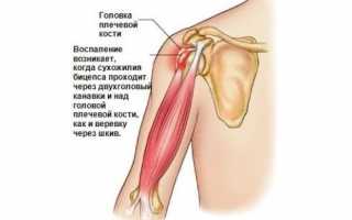 Особенности проявления тендинита плечевого сустава