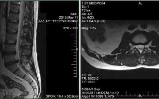 Как делают МРТ копчика и что показывает процедура?