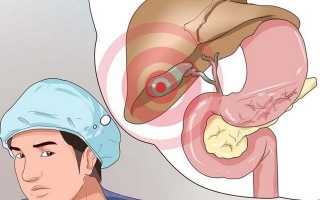 Чем опасен холестериновый полип желчного пузыря и можно ли его вылечить