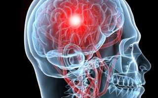 Улучшаем мозговое кровообращение при остеохондрозе шеи