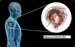 Признаки разрыва суставной губы плечевого сустава