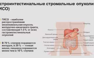 Гастроинтестинальная стромальная опухоль