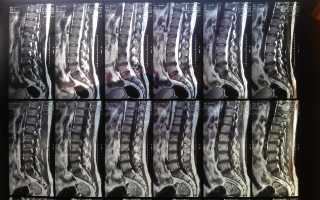 Как делают МРТ пояснично-крестцового отдела позвоночника?