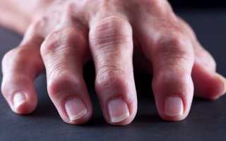 Каковы причины артроза пальцев рук и как его лечить?