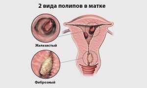 Можно ли отличить миому от полипа в матке и есть ли разница в их лечении