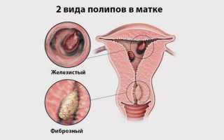 Можно ли отличить миому от полипа в матке и есть ли разница в их лечении