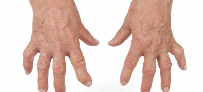 Как проявляется синдром Фелти и чем его лечить?