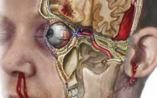 Виды, лечение и последствия перелома основания черепа