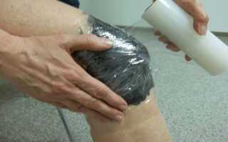 Делаем компрессы при лечении артроза коленного сустава