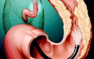 Диагностика и варианты лечения полипа двенадцатиперстной кишки