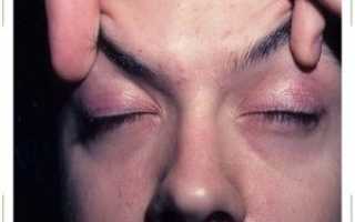 Болит глаз при моргании
