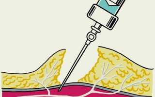 Какие виды анестезии применяют при проведении колоноскопии кишечника и какой из них выбрать