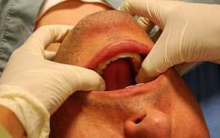 Первая помощь и методы лечения при вывихе челюсти