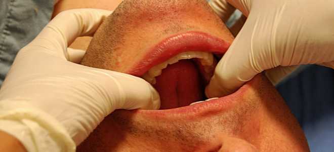 Первая помощь и методы лечения при вывихе челюсти