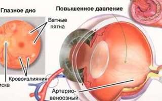 Как лечить глазное давление в домашних условиях