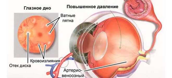 Как лечить глазное давление в домашних условиях