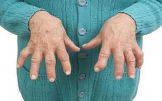 Причины воспаления суставов пальцев рук и как его снять