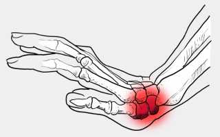Что делать при переломе ладьевидной кости запястья?