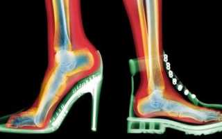 Как проводят рентгенографию стопы и что она показывает?