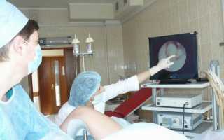 Способы удаления полипа эндометрия и надо ли соглашаться на гистероскопию