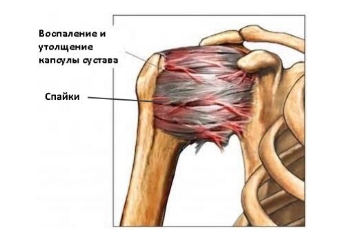 Капсулит плеча
