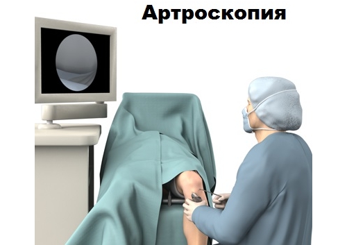 Проведение артроскопии